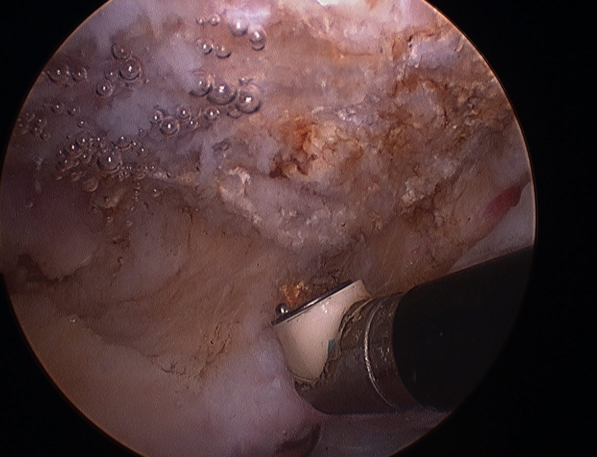 Arthroscopy Type 3 Acromion